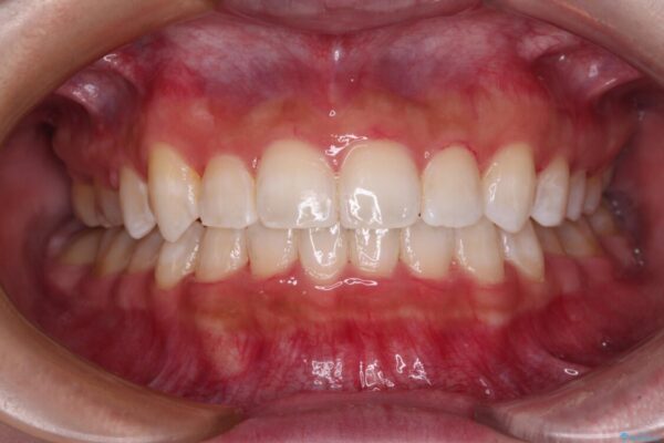 八重歯を改善　目立たないワイヤー装置での矯正治療 アフター