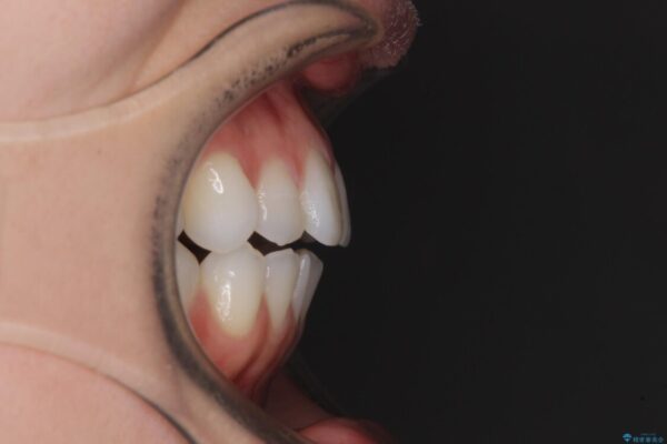 上下前歯が接触しない　オープンバイトをインビザラインで改善 治療前画像
