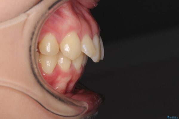 上顎前突　目立たないワイヤー装置での抜歯矯正 治療前画像
