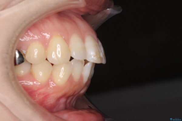 口元の突出感改善　なるべく銀歯を抜歯してワイヤー矯正 治療前画像