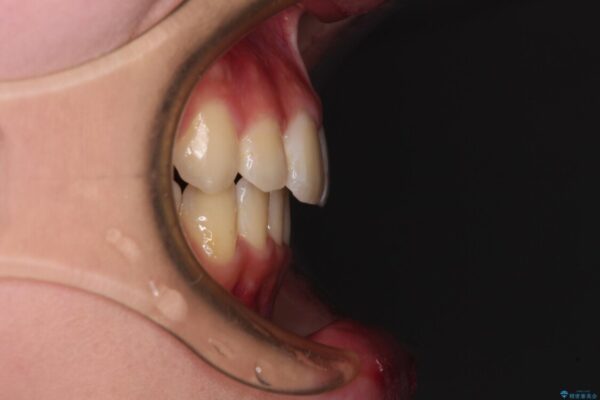 短期間で口元の突出感を改善　ワイヤー装置での抜歯矯正 治療後画像