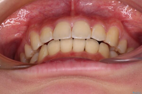 短期間で口元の突出感を改善　ワイヤー装置での抜歯矯正 治療後画像