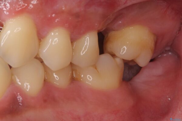 事故で抜歯となった前歯　ブリッジやインプラントによる補綴治療 治療前画像