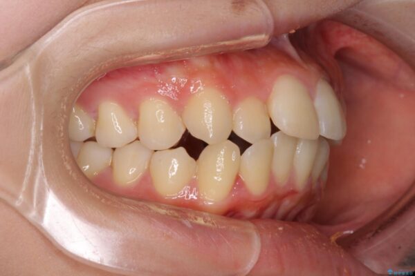 短期間で口元の突出感を改善　ワイヤー装置での抜歯矯正 治療前画像