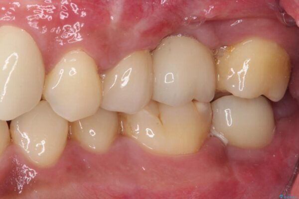 事故で抜歯となった前歯　ブリッジやインプラントによる補綴治療 治療後画像