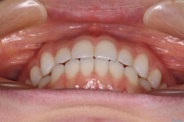 上下前歯が接触しない　オープンバイトをインビザラインで改善 治療後画像
