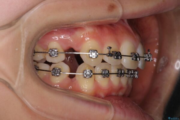 短期間で口元の突出感を改善　ワイヤー装置での抜歯矯正 治療途中画像