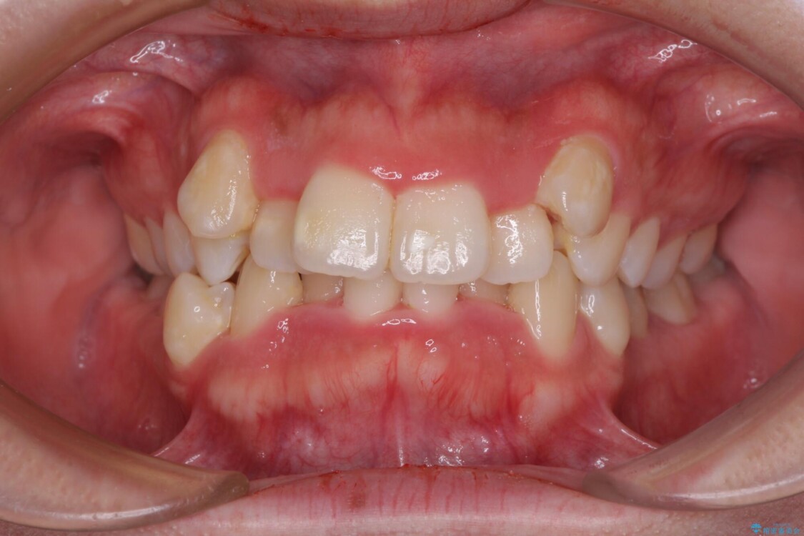 【モニター】八重歯を抜歯矯正でスッキリした口元に 治療前