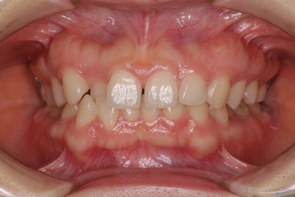 【モニター】前歯の歯列不正をワイヤー装置で短期間矯正治療 ビフォー