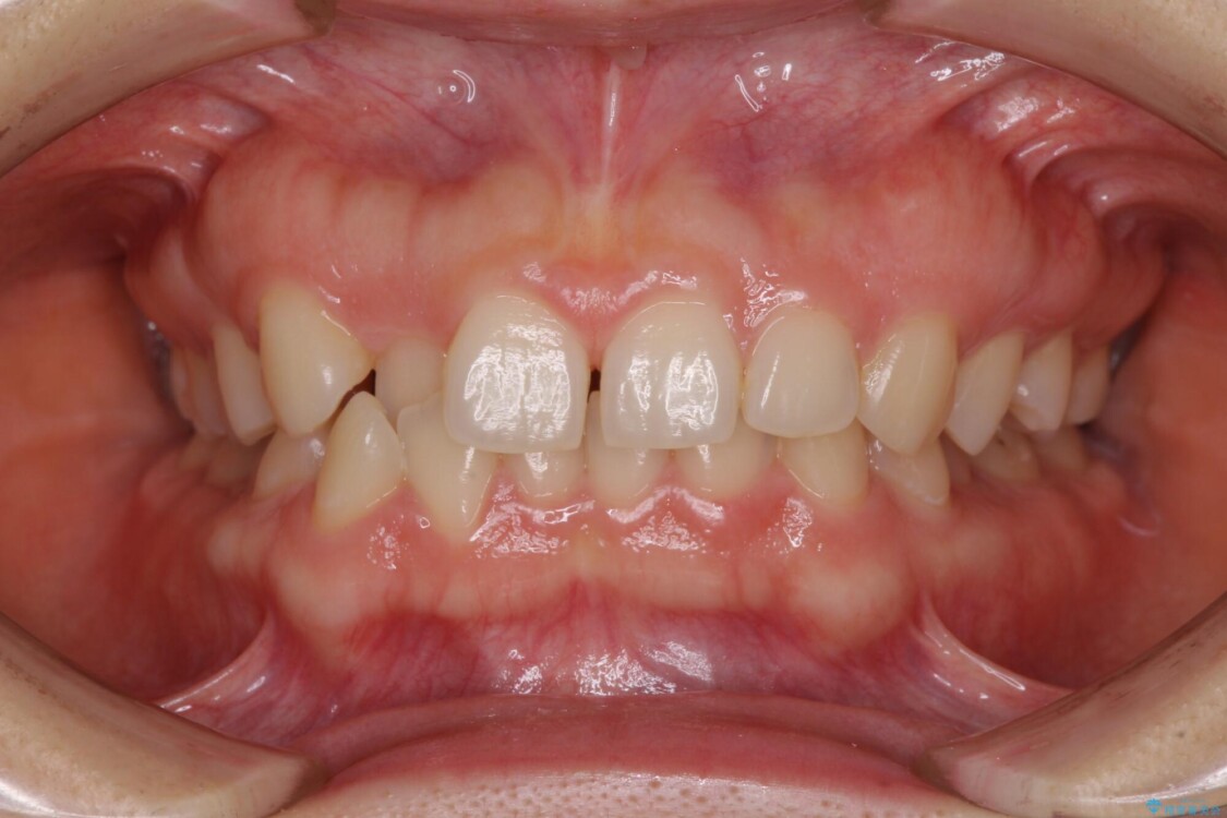 【モニター】前歯の歯列不正をワイヤー装置で短期間矯正治療 治療前