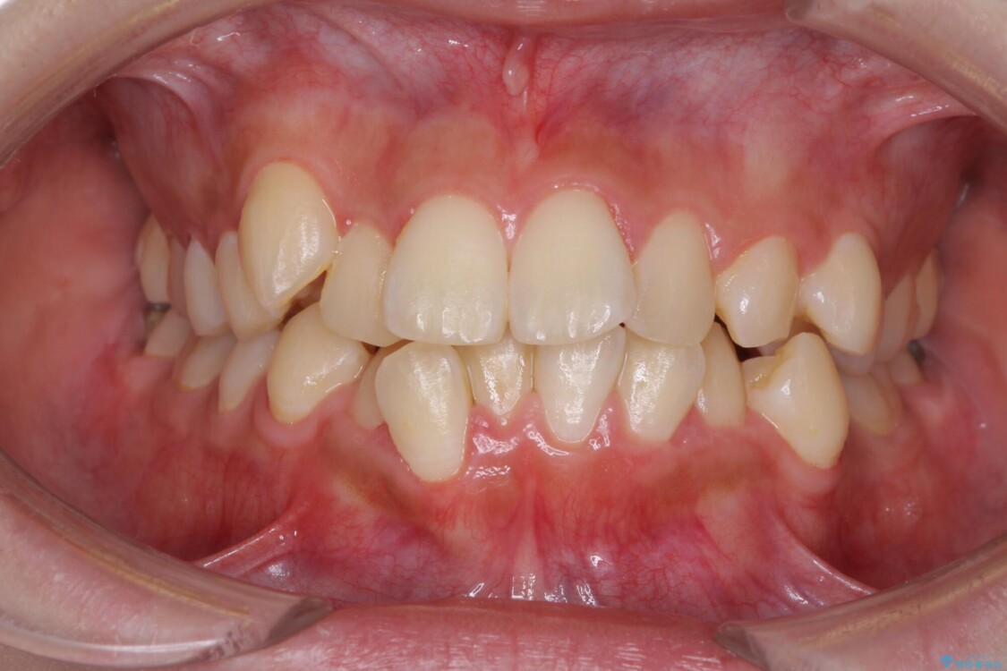 インビザラインが続けられない　ワイヤー矯正での抜歯矯正　その1 治療前