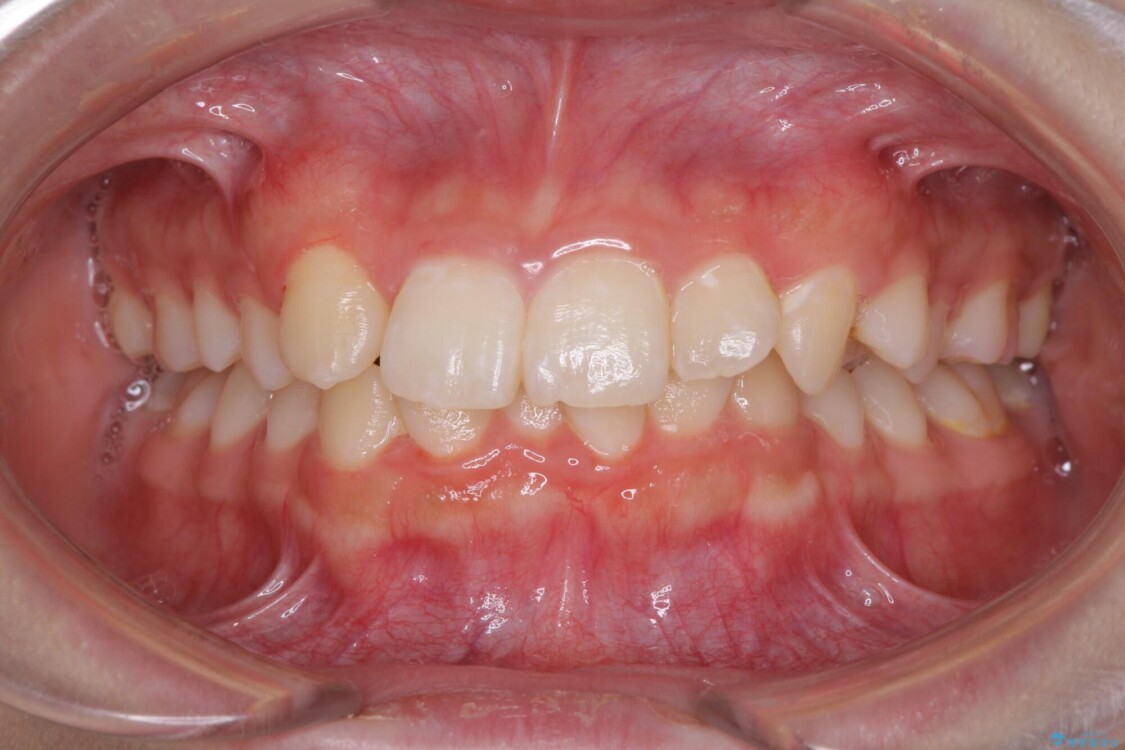 インビザラインが続けられない　ワイヤー矯正での抜歯矯正　その2 治療前