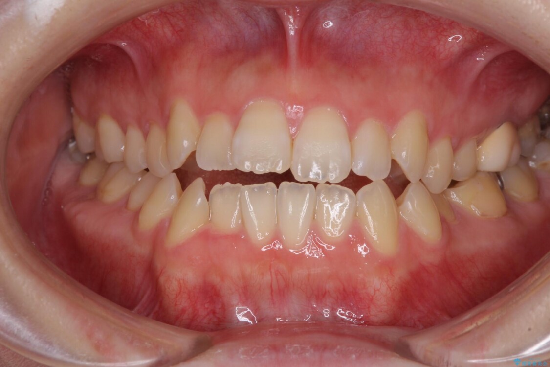 オープンバイトと前歯のデコボコをインビザライン矯正で解消 治療前