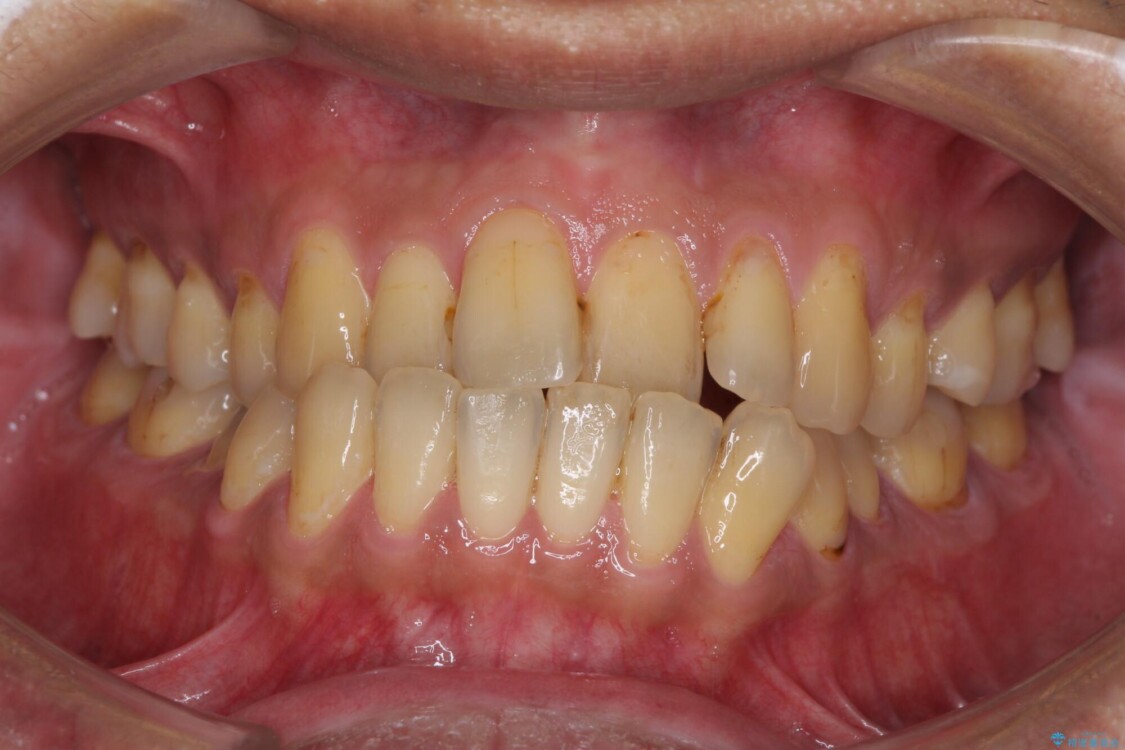 前歯のクロスバイトを改善　ワイヤー装置での非抜歯矯正 治療前