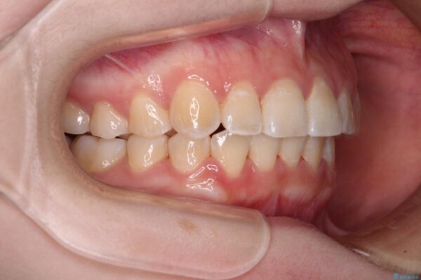 【モニター】前歯のデコボコを目立たないワイヤー装置で短期間矯正治療 治療後画像