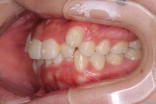 【モニター】八重歯を抜歯矯正でスッキリした口元に 治療前画像