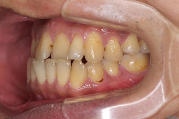 前歯のクロスバイトを改善　ワイヤー装置での非抜歯矯正 治療前画像
