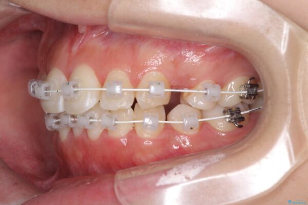 インビザラインが続けられない　ワイヤー矯正での抜歯矯正　その1 治療途中画像