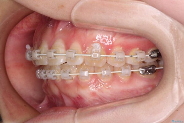 【モニター】前歯のデコボコを目立たないワイヤー装置で短期間矯正治療 治療途中画像