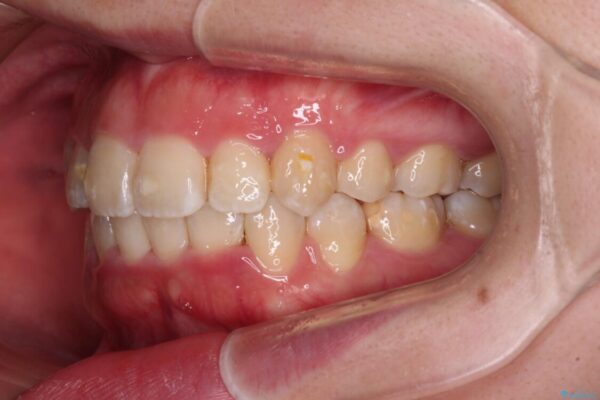 【モニター】八重歯を抜歯矯正でスッキリした口元に 治療後画像