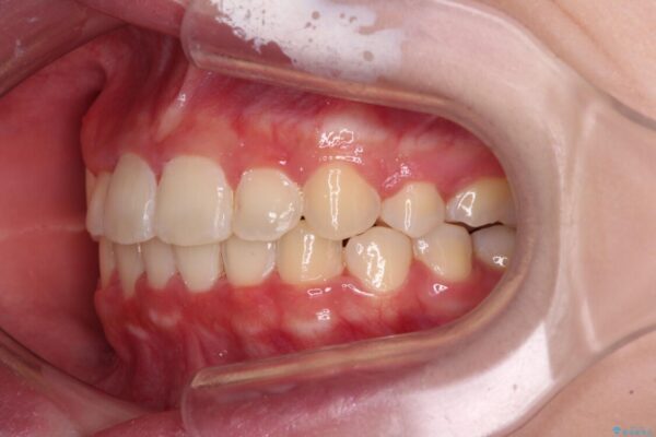 インビザラインが続けられない　ワイヤー矯正での抜歯矯正　その2 治療後画像