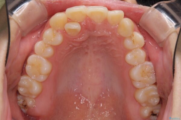 インビザラインが続けられない　ワイヤー矯正での抜歯矯正　その2 治療前画像