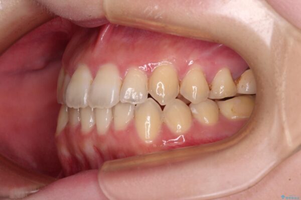 オープンバイトと前歯のデコボコをインビザライン矯正で解消 治療後画像