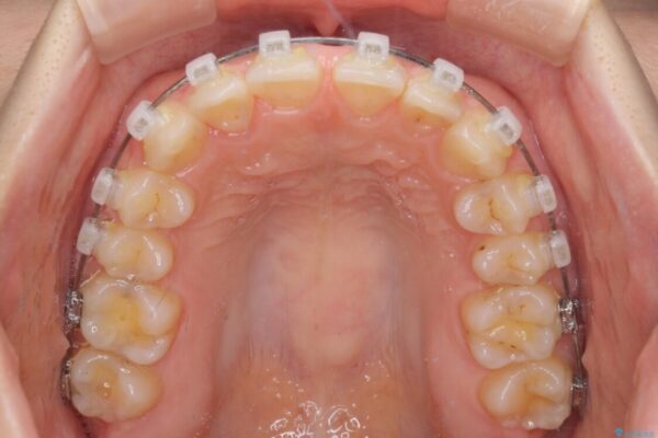 【モニター】前歯の歯列不正をワイヤー装置で短期間矯正治療 治療途中画像