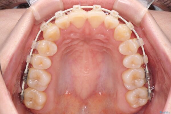 【モニター】前歯のデコボコを目立たないワイヤー装置で短期間矯正治療 治療途中画像