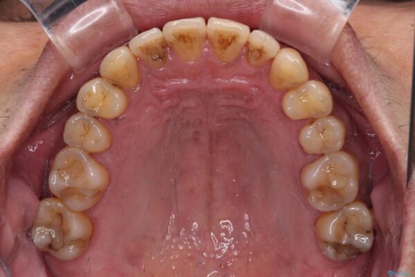 前歯のクロスバイトを改善　ワイヤー装置での非抜歯矯正 治療後画像