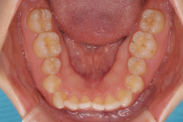 【モニター】前歯の歯列不正をワイヤー装置で短期間矯正治療 治療前画像