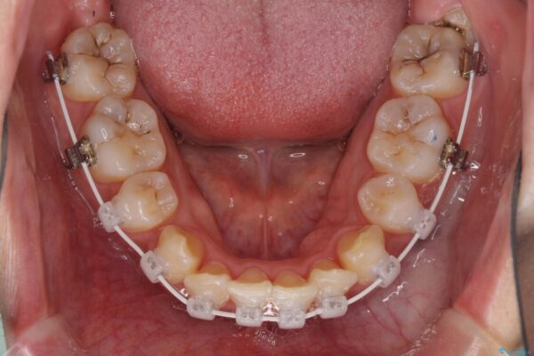 インビザラインが続けられない　ワイヤー矯正での抜歯矯正　その1 治療途中画像