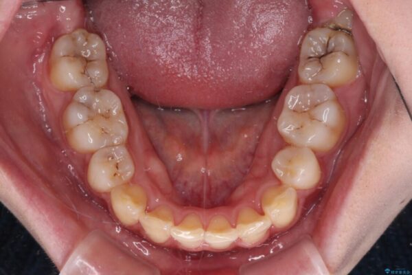インビザラインが続けられない　ワイヤー矯正での抜歯矯正　その1 治療後画像