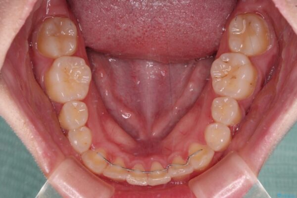インビザラインが続けられない　ワイヤー矯正での抜歯矯正　その2 治療後画像