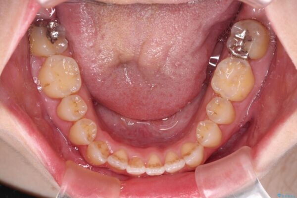 オープンバイトと前歯のデコボコをインビザライン矯正で解消 治療途中画像