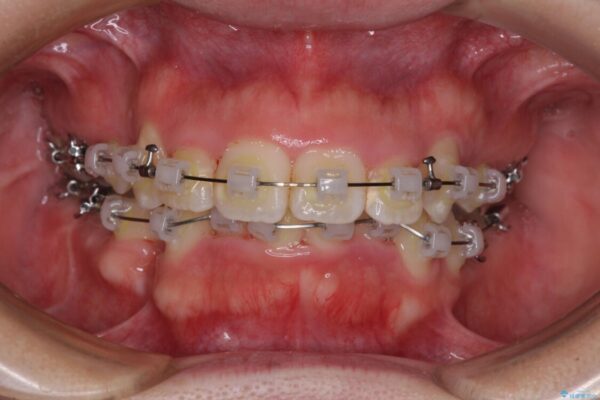 【モニター】八重歯を抜歯矯正でスッキリした口元に 治療途中画像