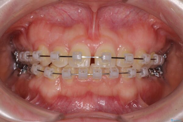 【モニター】前歯の歯列不正をワイヤー装置で短期間矯正治療 治療途中画像