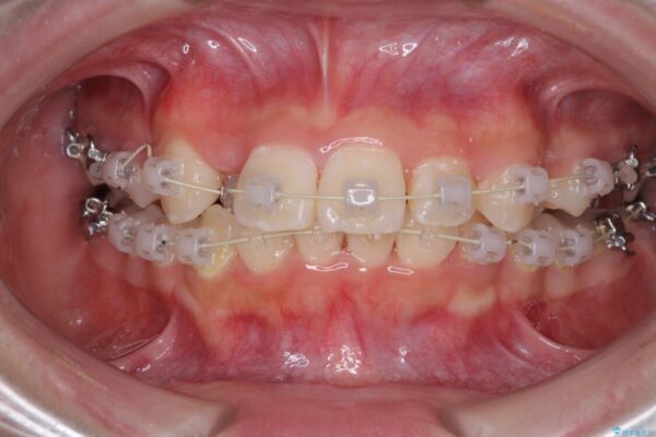 インビザラインが続けられない　ワイヤー矯正での抜歯矯正　その2 治療途中画像
