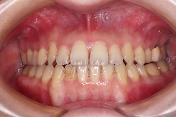 オープンバイトと前歯のデコボコをインビザライン矯正で解消 治療途中画像