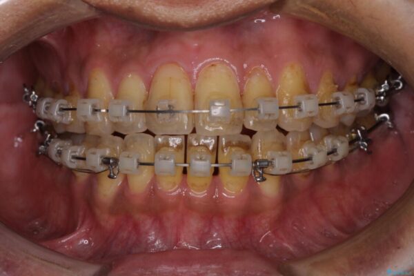 前歯のクロスバイトを改善　ワイヤー装置での非抜歯矯正 治療途中画像