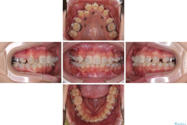 インビザラインが続けられない　ワイヤー矯正での抜歯矯正　その2 治療途中画像
