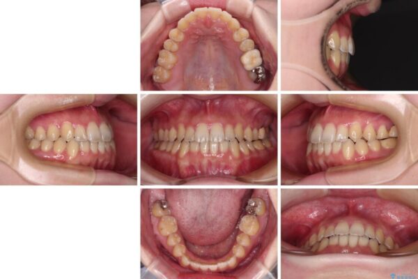 オープンバイトと前歯のデコボコをインビザライン矯正で解消 治療後画像