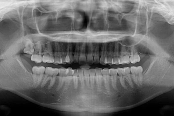 【モニター】前歯のデコボコを目立たないワイヤー装置で短期間矯正治療 治療前画像