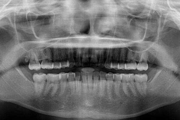 【モニター】前歯のデコボコを目立たないワイヤー装置で短期間矯正治療 治療後画像