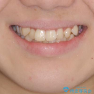 インビザラインが続けられない　ワイヤー矯正での抜歯矯正　その1 治療前画像