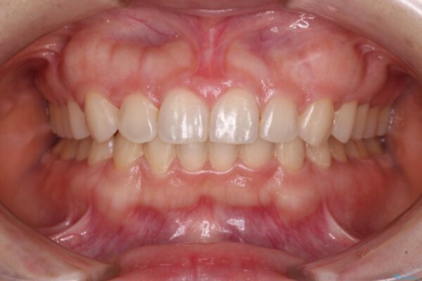 【モニター】前歯の歯列不正をワイヤー装置で短期間矯正治療 アフター