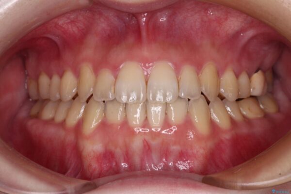 オープンバイトと前歯のデコボコをインビザライン矯正で解消 アフター