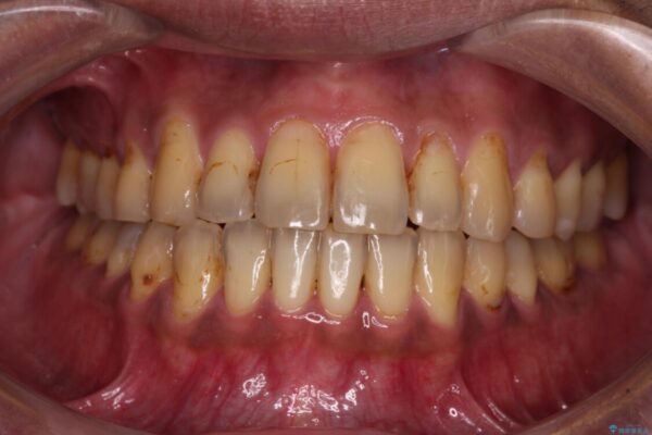 前歯のクロスバイトを改善　ワイヤー装置での非抜歯矯正 アフター