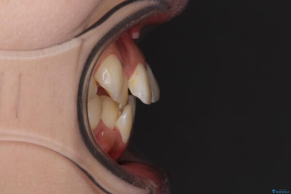 インビザラインが続けられない　ワイヤー矯正での抜歯矯正　その1 治療前画像