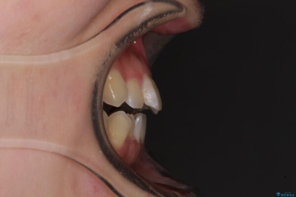 オープンバイトと前歯のデコボコをインビザライン矯正で解消 治療前画像